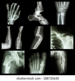 Collection Of Bone Fracture