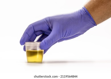 collection bottle with urine being handled by blue gloved hand, EAS urine test - Abnormal Sediment Elements, serves to analyze the pH of the urine. lab exam