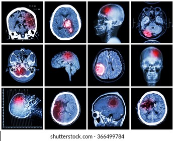 Collection Of Brain Disease ( CT Scan And MRI Of Brain : Show Cerebral Infarct , Intracerebral Hemorrhage , Brain Tumor , Basal Ganglia Hemorrhage ( Status Post Craniotomy ) ) ( Health Care Concept )