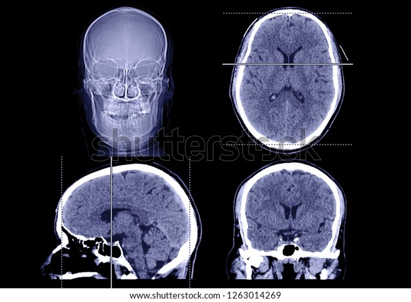 Collection Ct Scan Brain Axial Sagittal Stock Photo Edit Now 1263014269