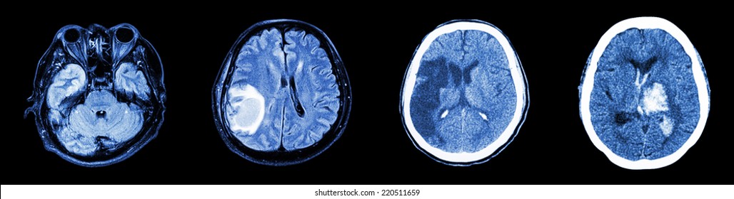 Collection CT Scan Of Brain And Multiple Disease (Left To Right  :  Normal Brain,Brain Tumor,Cerebral Infarction,Intracerebral Hemorrhage)