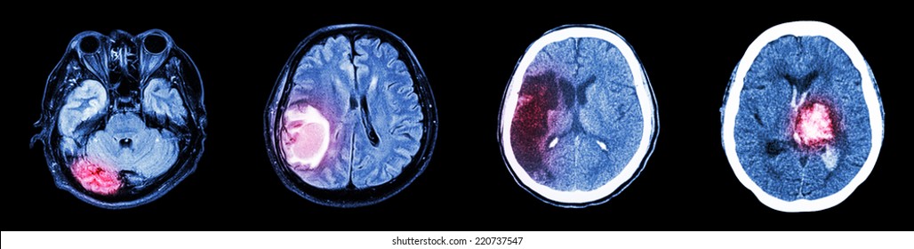 Collection CT Scan Of Brain And Multiple Disease (Left To Right  :  Normal Brain,Brain Tumor,Cerebral Infarction,Intracerebral Hemorrhage)