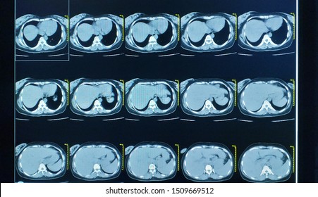 Collection CT Scan Upper Abdomen A Woman 35 Year Old Impression: Mass At Pancreatic Tail ,diagnosis Pancreas,lymphoma Medical Healthcare And Technology Concept.