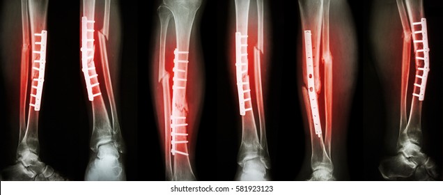 Collection image of leg fracture and surgical treatment by internal fixation with plate and screw . Break tibia and fibula bone .