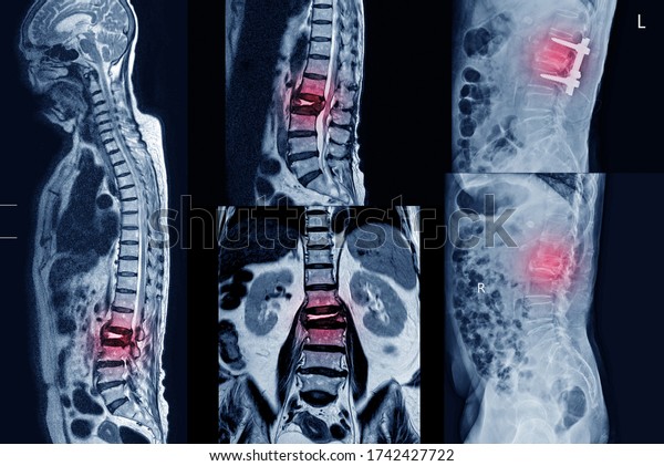Collection MRI of lumbar spine History of fall\
with back pain, radiate to leg, rule out spinal stenosis\
.Impression:Burst fracture of L2 vertebral body with severe\
vertebral collapse.Medical\
concept.