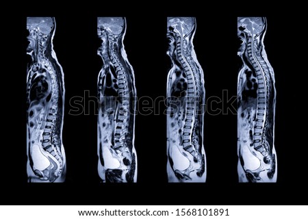 Collection of MRI of whole spine  T2W sagittal  plane for diagnostic Spinal Cord Compression.