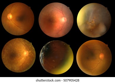 Collection of Photo Madical Retina Abnormal isolated on black background.Retina of diabetes , diabates retinopathy.