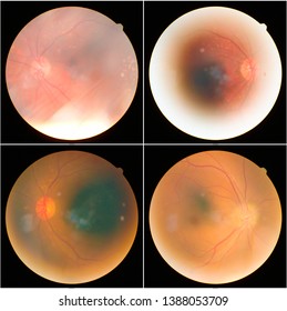 collection of Retinal image  of the patient taken with retinal photography machine.