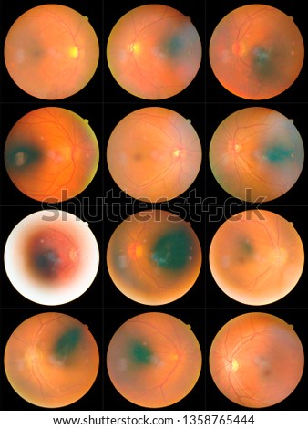 collection of Retinal image  of the patient taken with retinal photography machine.