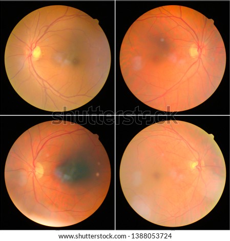 collection of Retinal image  of the patient taken with retinal photography machine.