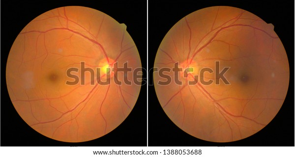 retinacapture retinacapture