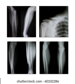 1,007 Xray Spine Report Images, Stock Photos & Vectors | Shutterstock