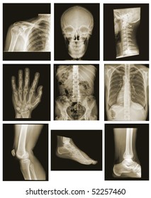 Collection Xray Isolated On Black Background Stock Photo 52257460 ...