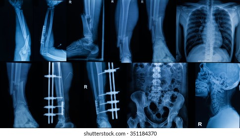 Collection Image Leg Fracture Surgical Treatment Stock Photo (Edit Now ...