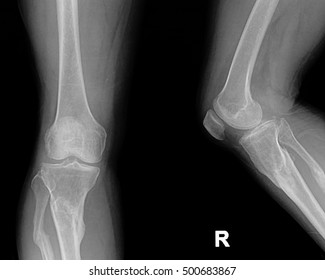 Collection Xray Normal Knee Stock Photo 500683867 | Shutterstock