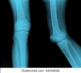 Xray Knee Showing Closed Fracture Displacement Stock Photo (edit Now 