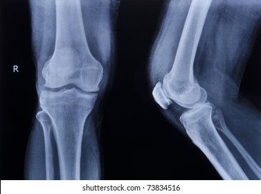 collection of x-ray normal knee