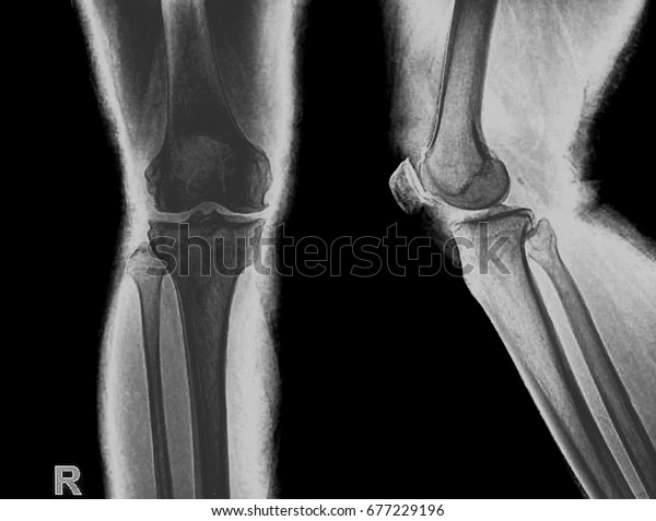 Collection Xray Normal Knee Stock Photo (Edit Now) 677229196