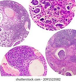 College Of Four Photomicrograph Showing Invasive Ductal Carcinoma (IDC) Grade-II, Most Common Form Of Breast Cancer. Lymphovascular Invasion: Present