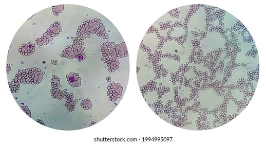 College Of Two Microscopic Image Of Blood Smear Showing Abnormal Low Volume Of Platelets (Thrombocytopenia). Low Blood Thrombocytes Count