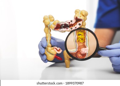 Colon model with different diseases in doctors hands. Colon tumor enlarged in a magnifying glass