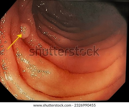 A colon polyp found in the large intestine of a person with Lynch Syndrome during a colonoscopy.  Stock foto © 
