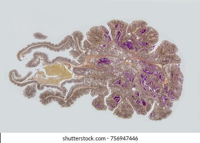 Colon Polyp Is One Of The Largest Exostosis