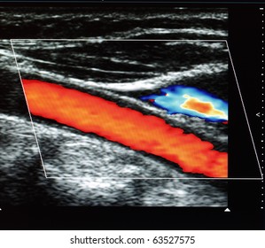 Color Doppler flow imaging of human Carotid artery