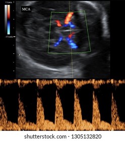 Color Doppler Ultrasound Of Fetal Brain (Middle Cerebral Arteries ) Many Other Radiological Images (CT, MRI, PET CT, X-ray) In My Portfolio