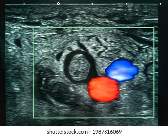 Color Doppler Ultrasound Image Of Common Femoral Deep Vein Thrombosis