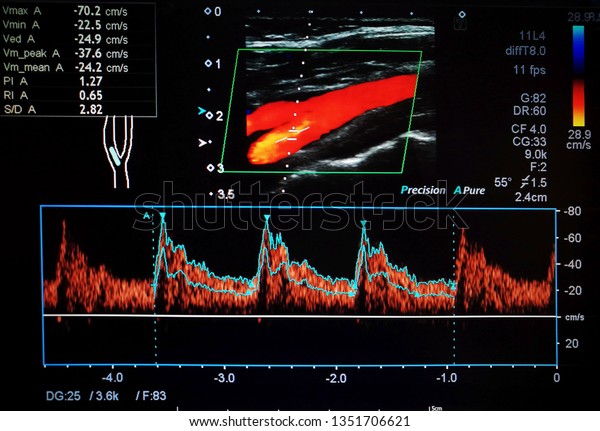 carotid doppler ultrasound normal values