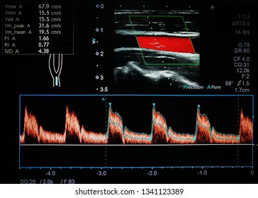 doppler ultrasound pregnancy