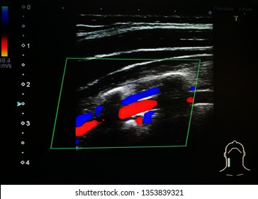 Color Doppler Ultrasound Of Vertebral Artery And Vein