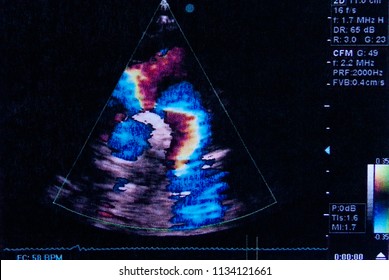 Color image of the ultrasound examination result. Made in an Ultrasound Machine. Human heart. Inter auricular communication (CIA)