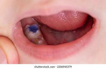 Colored Blue Filling In A Child's Tooth After Caries Treatment. Modern Medicine With Colorful Fillings For Children. Close-up