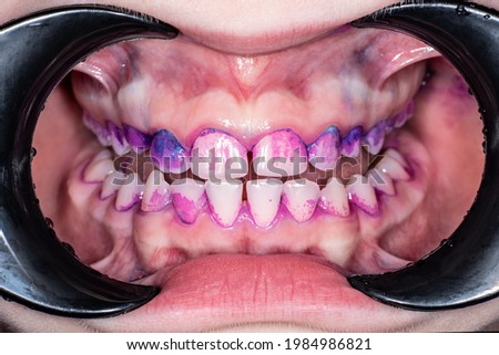 Colored plaque on a child's teeth close-up.Front view of human teeth.Permanent teeth in the mouth.Teeth staining before professional oral hygiene treatment.