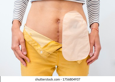 Colostomy bag on person, person with scar, front view of person, colostomy bag on person