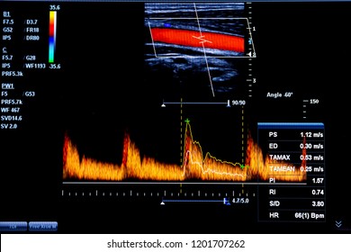 Colourful image of modern ultrasound monitor. Ultrasonography machine. High technology medical and healthcare equipment. Ultrasound imaging or sonography used in medicine. Carotid artery.