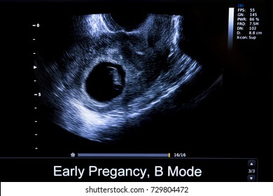 Colourful image of modern ultrasound monitor. Ultrasonography machine. High technology medical and healthcare equipment. Early pregnancy. Woman's womb during pregnancy.