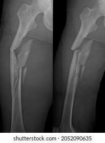 Cominutive Bone Fracture  Xray Radiology