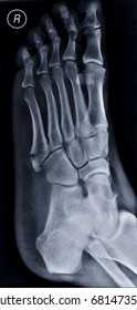 Comminuted Fracture Of Metatarsal Bone