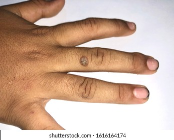 Common wart at dorsal surface of middle finger in Southeast Asian, Myanmar child. It is small growth with a rough texture that looks like a solid blister or a cauliflower. Isolated on white background