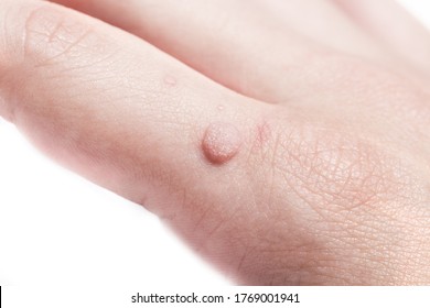 Common wart  Verruca vulgaris  a flat wart commonly found on the hand of children and adults. They are caused by a type of human papillomavirus  HPV.