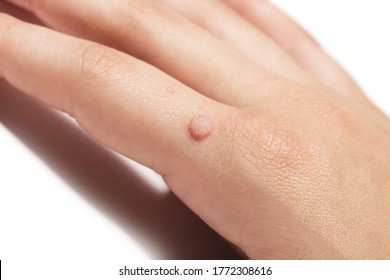 Common warts hpv type, Which hpv virus causes common warts