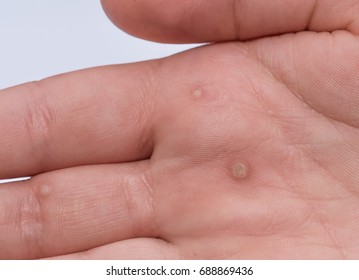 Common wart ( Verruca vulgaris ) a flat wart commonly found on the hands and feet of children and young adults. They are caused by a type of human papillomavirus ( HPV ) 