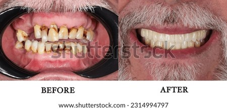 Comparative collage Before and After. Installation of veneers. Chronic generalized Paradontitis. Severe Gum disease. Dentist office. Wedge-shaped defect. Smoker plaque