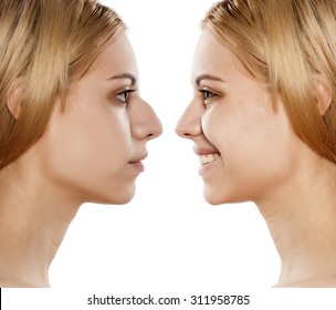 comparative portrait of female face, before and after plastic surgery of the nose