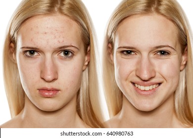 Comparative portrait of female face, before and after cosmetic treatment
