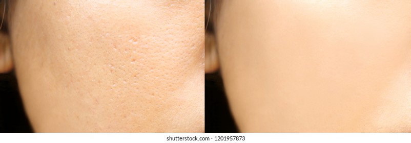 Compare Before And After (retouch Photo) Of Close Up Wide Pores Skin On Oily Face Have Pimple Of Asia Woman