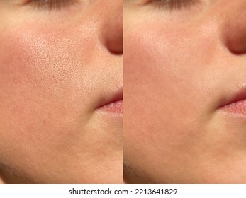 Compare before and after (retouch photo) of close up wide large pores skin on oily face have pimple. Effect after use cream or treatment for facial care face skin to better